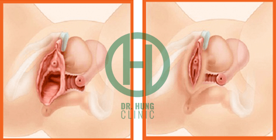 Hình ảnh minh họa trước và sau thu nhỏ cô bé tại Dr Hùng Clinic