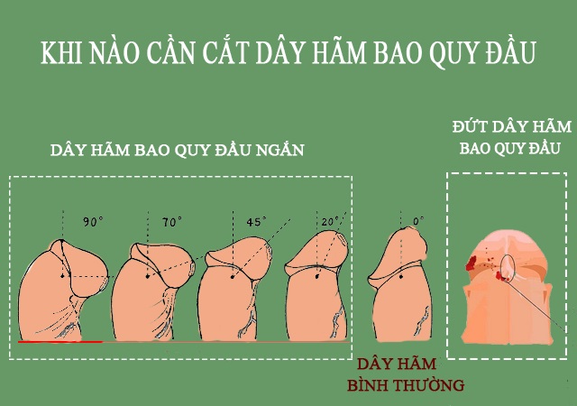 truong-hop-can-cat-day-chang-quy-dau
